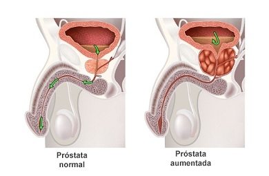 prostata con adenoma bilobato carte prostatita si tratamentul ei
