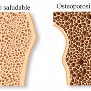 Osteoporosis